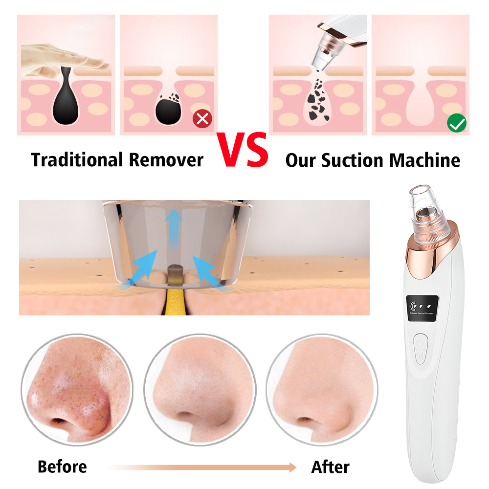 Blackhead Remover Vacuum Pore  - огляд і ціна Nasal Aspirator